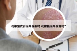 花椒紫皮蒜治牛皮癬嗎 花椒能治牛皮鮮嗎?