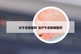 紅牛皮癬醫(yī)院 治療牛皮膚癬醫(yī)院