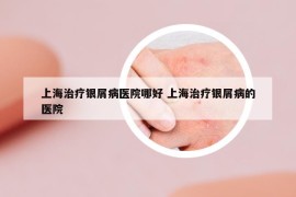 上海治療銀屑病醫(yī)院哪好 上海治療銀屑病的醫(yī)院