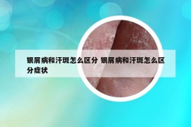 銀屑病和汗斑怎么區(qū)分 銀屑病和汗斑怎么區(qū)分癥狀
