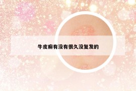 牛皮癬有沒有很久沒復(fù)發(fā)的