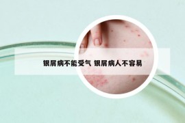銀屑病不能受氣 銀屑病人不容易