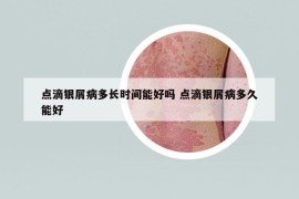 點滴銀屑病多長時間能好嗎 點滴銀屑病多久能好