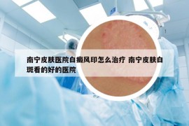 南寧皮膚醫(yī)院白癜風(fēng)印怎么治療 南寧皮膚白斑看的好的醫(yī)院