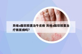 異維a酸軟膠囊治牛皮癬 異維a酸軟膠囊治療銀屑病嗎?