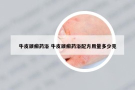 牛皮頑癬藥浴 牛皮頑癬藥浴配方用量多少克