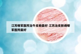 江蘇哪家醫(yī)院治牛皮癬最好 江蘇治皮膚病哪家醫(yī)院最好