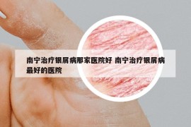 南寧治療銀屑病那家醫(yī)院好 南寧治療銀屑病最好的醫(yī)院