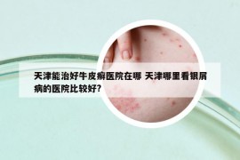 天津能治好牛皮癬醫(yī)院在哪 天津哪里看銀屑病的醫(yī)院比較好?