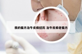 我的偏方治牛皮癬經(jīng)歷 治牛皮癬老偏方