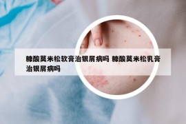 糠酸莫米松軟膏治銀屑病嗎 糠酸莫米松乳膏治銀屑病嗎