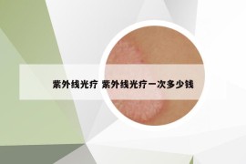 紫外線光療 紫外線光療一次多少錢
