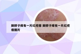 腳脖子癢有一片紅疙瘩 腳脖子癢有一片紅疙瘩圖片