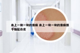 身上一塊一塊的像癬 身上一塊一塊的像癬很干燥起白皮