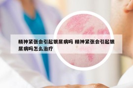 精神緊張會(huì)引起銀屑病嗎 精神緊張會(huì)引起銀屑病嗎怎么治療