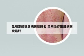 昆明正規(guī)銀屑病醫(yī)院排名 昆明治療銀屑病醫(yī)院最好