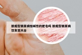 膿皰型銀屑病怕堿性的肥皂嗎 膿皰型銀屑病飲食禁大全