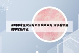 深圳哪家醫(yī)院治療銀屑病效果好 深圳看銀屑病哪家最專業(yè)