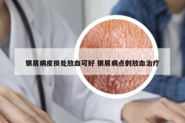 銀屑病皮損處放血可好 銀屑病點(diǎn)刺放血治療