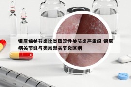 銀屑病關(guān)節(jié)炎比類風(fēng)濕性關(guān)節(jié)炎嚴(yán)重嗎 銀屑病關(guān)節(jié)炎與類風(fēng)濕關(guān)節(jié)炎區(qū)別