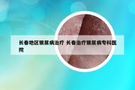 長春地區(qū)銀屑病治療 長春治療銀屑病?？漆t(yī)院