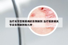 治療關(guān)節(jié)型銀屑病的生物制劑 治療銀屑病關(guān)節(jié)炎生物制劑有幾種