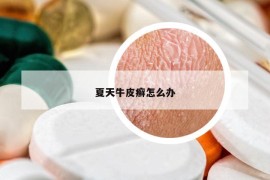 夏天牛皮癬怎么辦