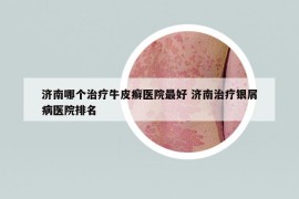 濟南哪個治療牛皮癬醫(yī)院最好 濟南治療銀屑病醫(yī)院排名