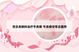 空總皮膚科治療牛皮癬 牛皮癬空軍總醫(yī)院