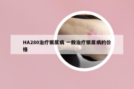 HA280治療銀屑病 一般治療銀屑病的價格