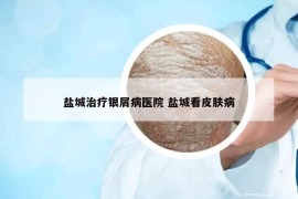 鹽城治療銀屑病醫(yī)院 鹽城看皮膚病