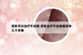 液氮可以治療牛皮癬 液氮治療牛皮癬最簡單三個步驟