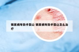 銀屑病導(dǎo)致手裂口 銀屑病導(dǎo)致手裂口怎么治療