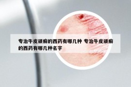 專治牛皮頑癬的西藥有哪幾種 專治牛皮頑癬的西藥有哪幾種名字