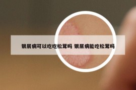 銀屑病可以吃吃松茸嗎 銀屑病能吃松茸嗎