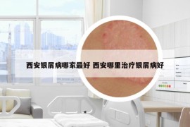 西安銀屑病哪家最好 西安哪里治療銀屑病好
