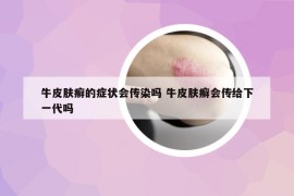 牛皮膚癬的癥狀會(huì)傳染嗎 牛皮膚癬會(huì)傳給下一代嗎