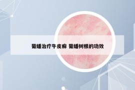 葡蟠治療牛皮癬 葡蟠樹根的功效