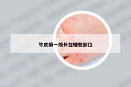 牛皮癬一般長在哪些部位