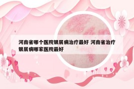 河南省哪個(gè)醫(yī)院銀屑病治療最好 河南省治療銀屑病哪家醫(yī)院最好