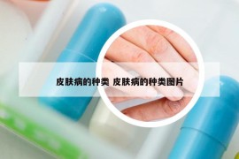 皮膚病的種類 皮膚病的種類圖片