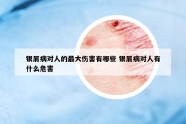 銀屑病對人的最大傷害有哪些 銀屑病對人有什么危害