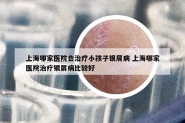 上海哪家醫(yī)院會(huì)治療小孩子銀屑病 上海哪家醫(yī)院治療銀屑病比較好