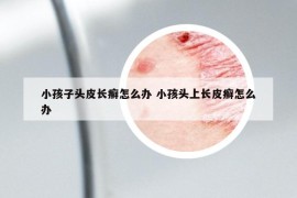 小孩子頭皮長癬怎么辦 小孩頭上長皮癬怎么辦