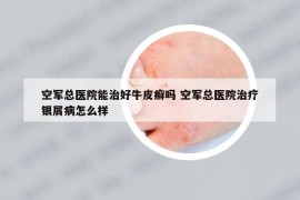 空軍總醫(yī)院能治好牛皮癬嗎 空軍總醫(yī)院治療銀屑病怎么樣