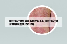 哈爾濱治銀屑病哪家醫(yī)院好不好 哈爾濱治銀屑病哪家醫(yī)院好不好呀