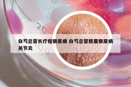 白芍總苷長(zhǎng)療程銀屑病 白芍總苷膠囊銀屑病關(guān)節(jié)炎