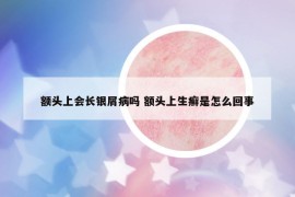額頭上會(huì)長(zhǎng)銀屑病嗎 額頭上生癬是怎么回事