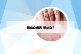 溫病白癜風 溫病白?