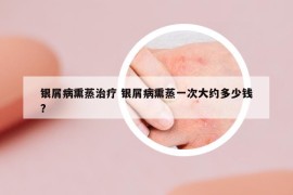 銀屑病熏蒸治療 銀屑病熏蒸一次大約多少錢?